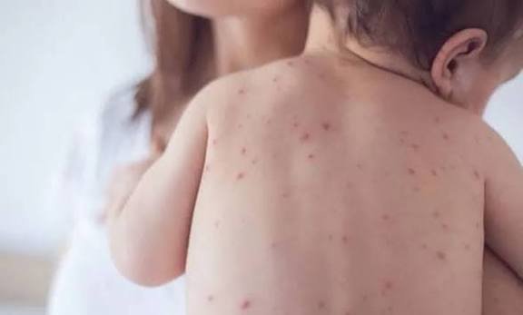 3 more children die from measles-like symptoms in 24hrs