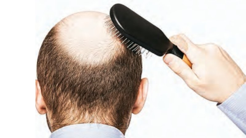 Can a Drug Cure Baldness? New Study Shows Potential