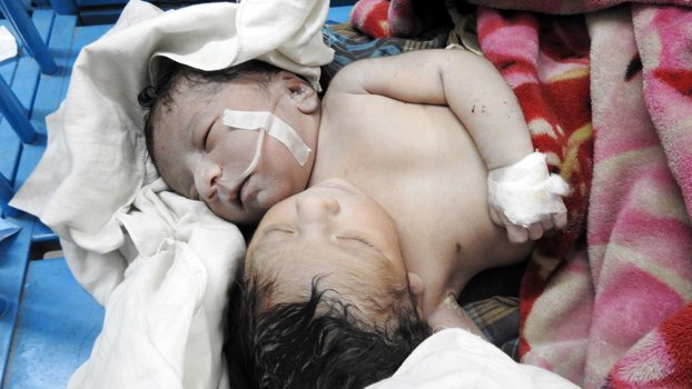 Two-headed baby born in Magura