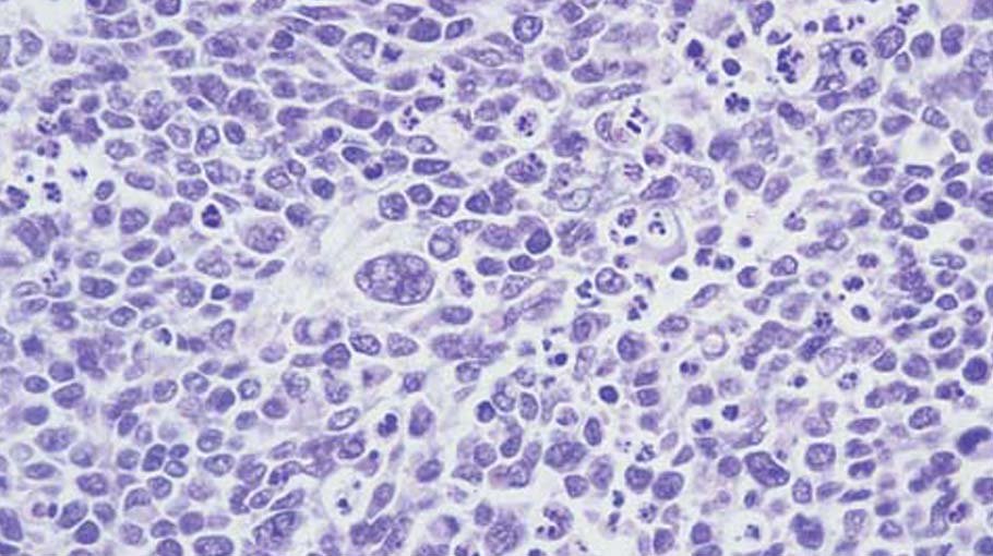 Treatment for rhabdomyosarcoma (part 4)