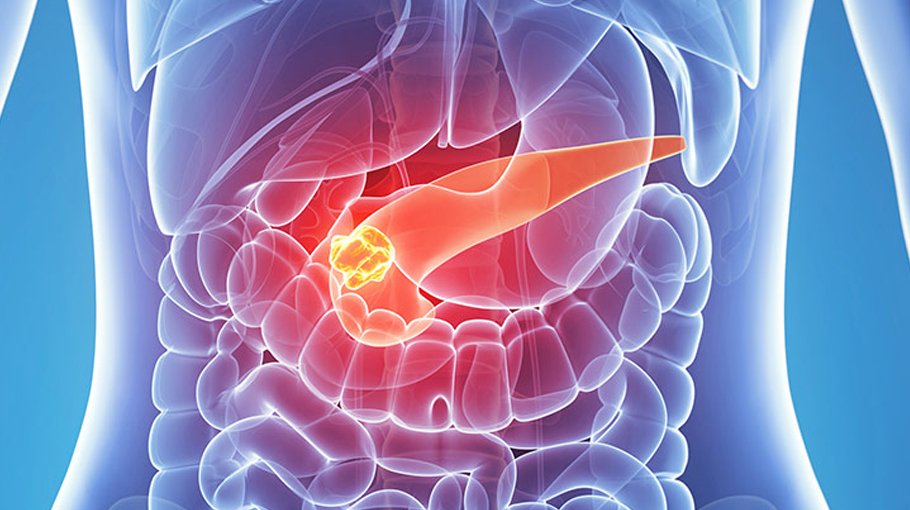 Causes, risk factors of  neuroendocrine  tumours (part 2)