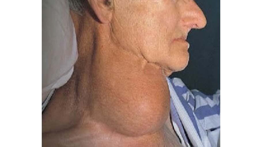 Causes, risk factors of lymphoma (part 2)