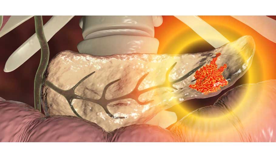 Treatment for pancreatic cancer (part 6)