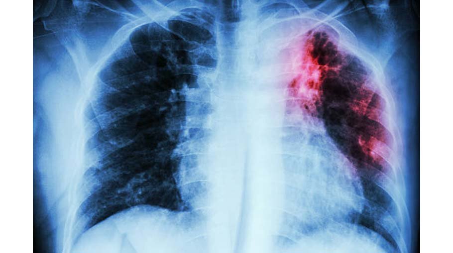 Pulmonary fibrosis (part 1) 