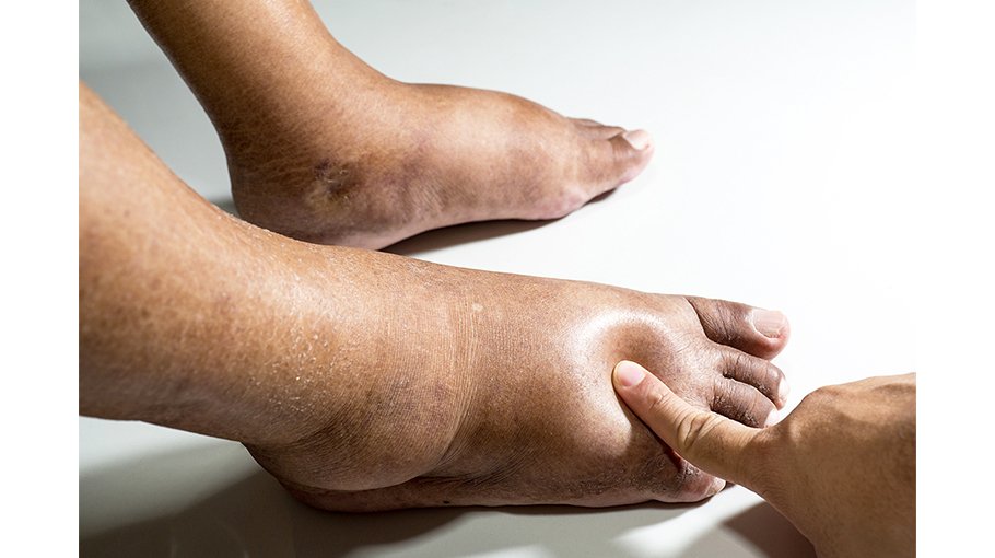 Other causes of edema (part 3)