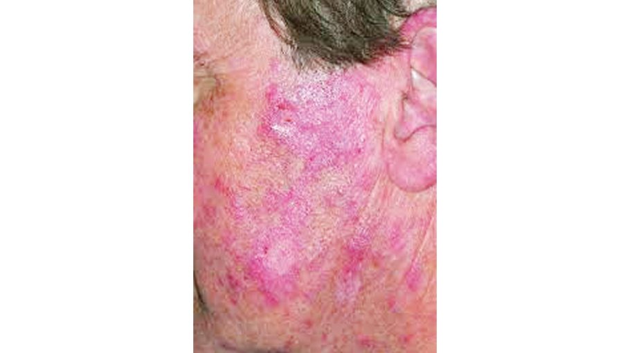 Complications of lupus (part 3)