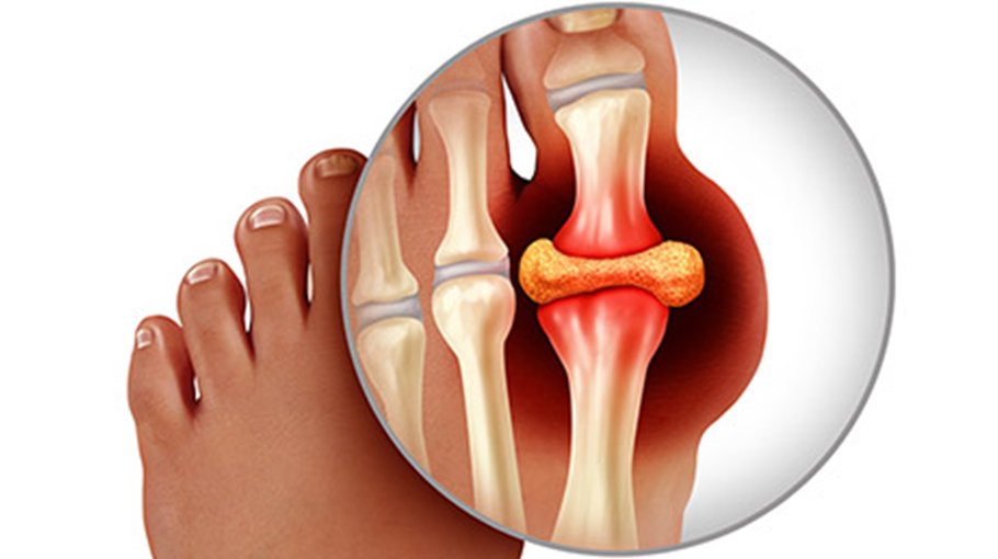 Medications to prevent gout complications (part 7)