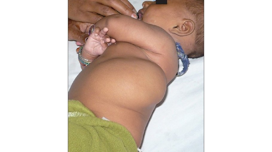 Causes of cystic hygroma (part 2)