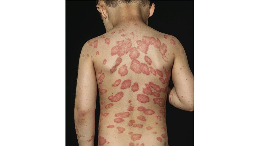 How to diagnose psoriasis (part 4)