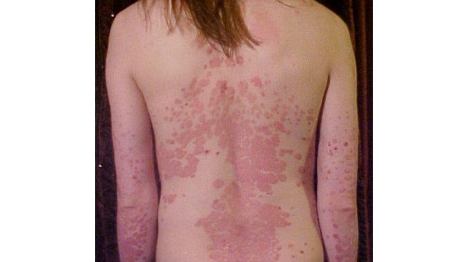 More therapy for  psoriasis (part 7)