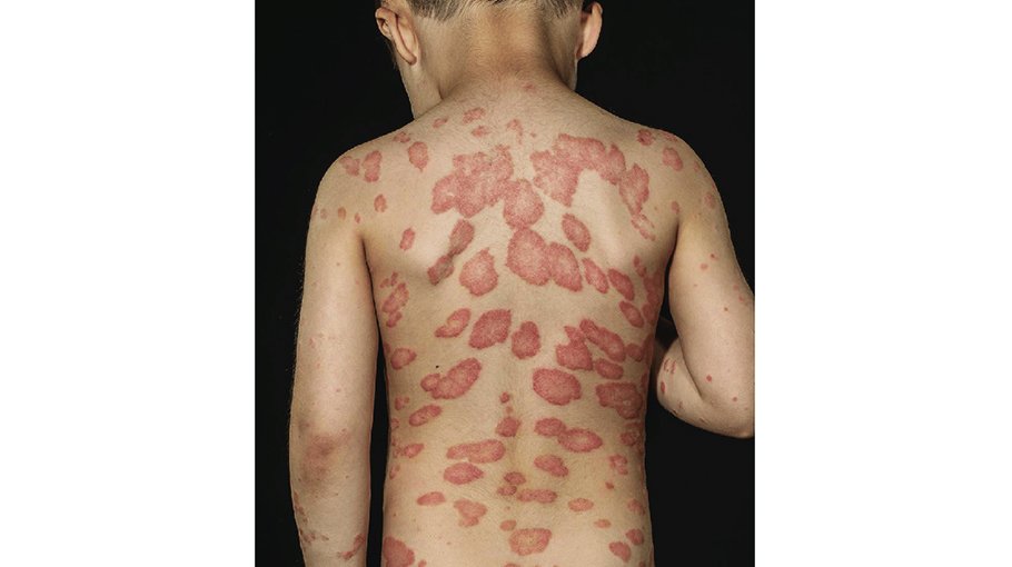 Alternative medicine for psoriasis (part 9)