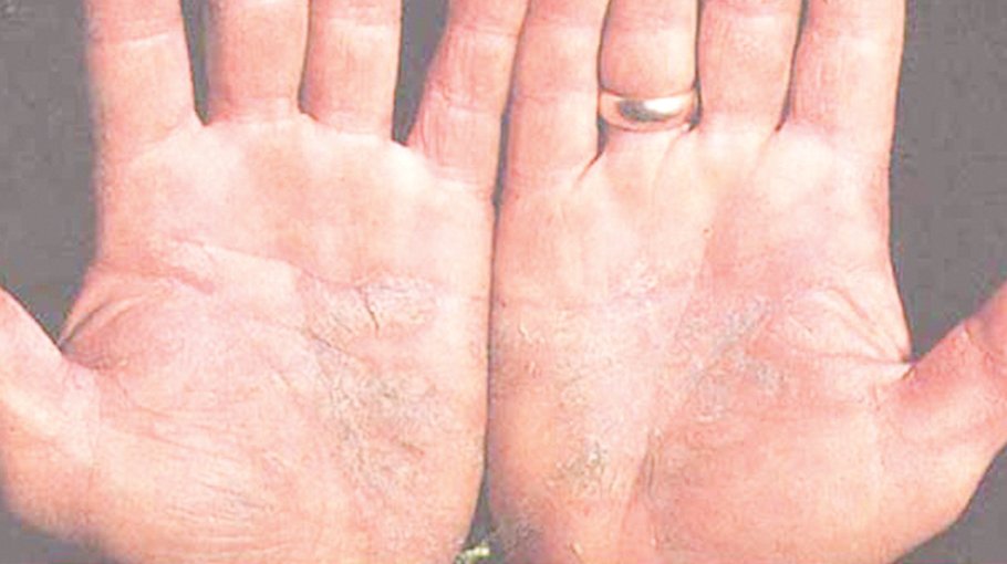  Home remedies for psoriasis (part 10)