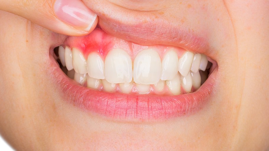 Periodontitis, its symptoms (part 1)