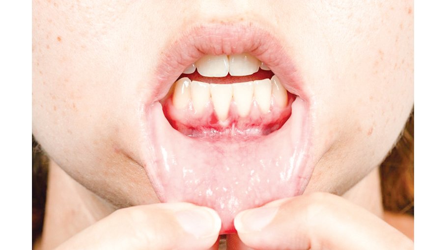 Risk factors, complications of periodontitis (part 3)