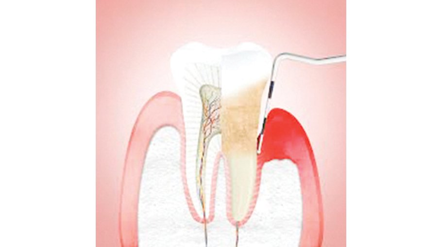How to diagnose  periodontitis (part 4)