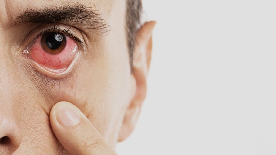 Eye diseases on the rise in Mirsharai