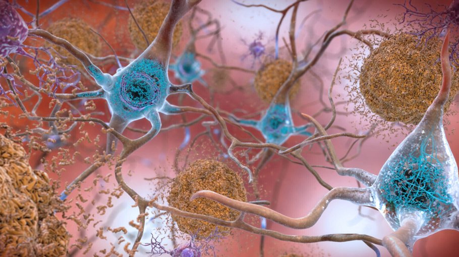 Blockbuster Alzheimer’s drug a scientific breakthrough