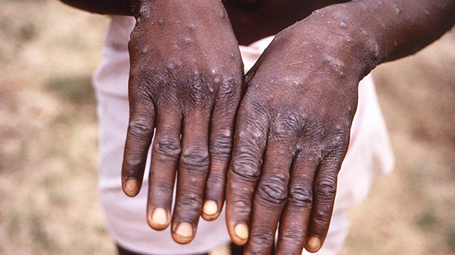 Over 18,700 mpox cases detected in Africa since January