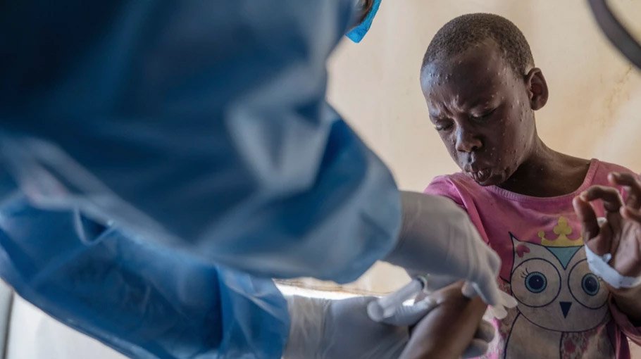 WHO grants use of vaccine against mpox in adults