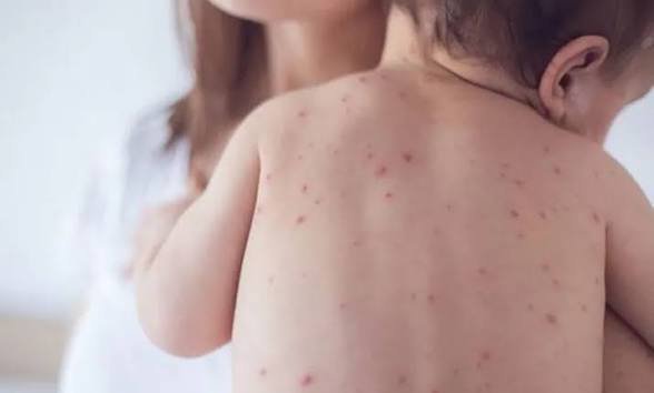 5 more children die from measles-like symptoms