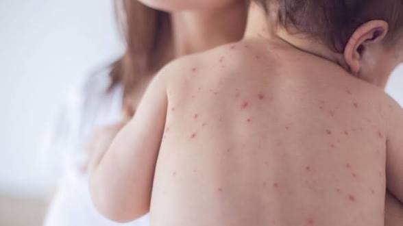 5 more children die from measles-like symptoms