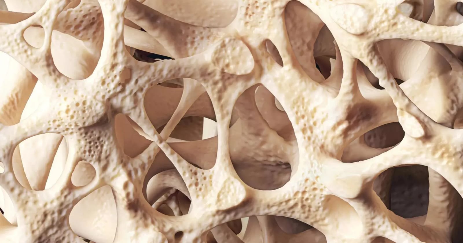 Osteopenia quietly weakening bones of millions worldwide